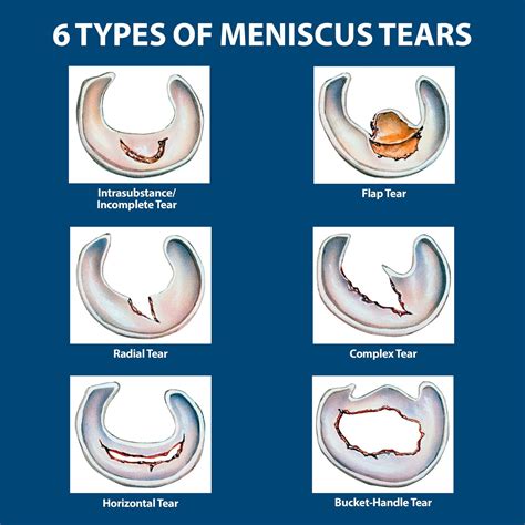 tear meniscus test eye|diagnose meniscus tear without mri.